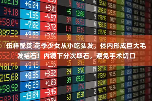 伍祥配资 花季少女从小吃头发，体内形成巨大毛发结石！内镜下分次取石，避免手术切口